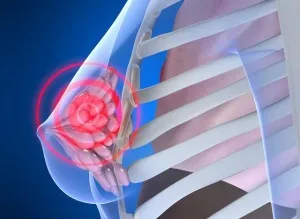 Mamară adenocarcinom prognosticul supraviețuirii, speciile și stadiul de tratament