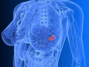 adenocarcinom mamar (cancer glandular), ceea ce este și prognoza