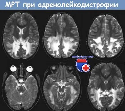 Адренолевкодистрофия при децата предизвиква, диагностика, лечение