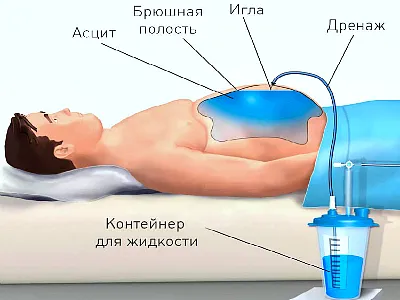 ascită abdominale (lichid în abdomen), care este provoacă la bărbați și femei