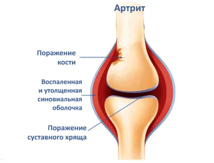 Артрит и артроза, каква е разликата на тези или подобни заболявания