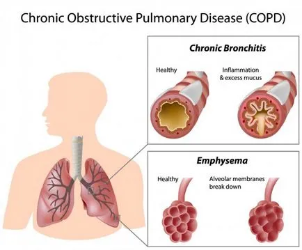 Astmatică Bronșită cauze, simptome, diagnostic, tratament