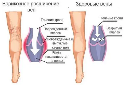 Да вземе армията с разширени крака 1, 2, 3 градуса, прегледи и консултации на лекарите