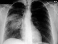 Blastomycosis - cauze, simptome, diagnostic și tratament