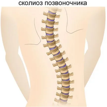 Cât de periculos este scoliozei coloanei vertebrale simptome, semne si tratament