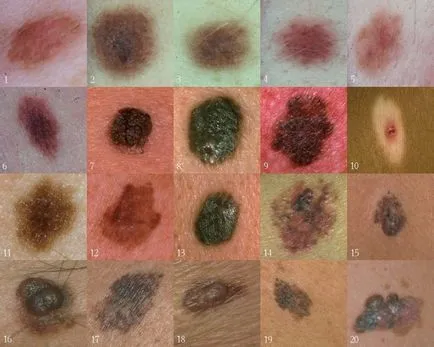 Ce este piele melanom - tratament, semne și simptome ale bolii