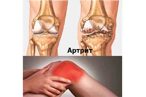 Diéta rheumatoid arthritis Arthritis az ízületek, a táplálkozás, az étrend-napra