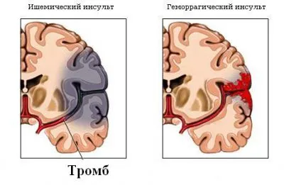 Diagnózis ischaemiás és vérzéses gutaütés eltérés és topikális