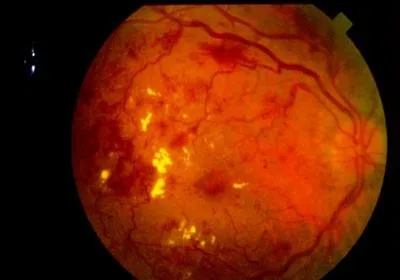 diabetikus retinopátia