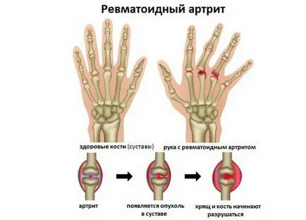 Диета при ревматоиден артрит ставите правилното хранене