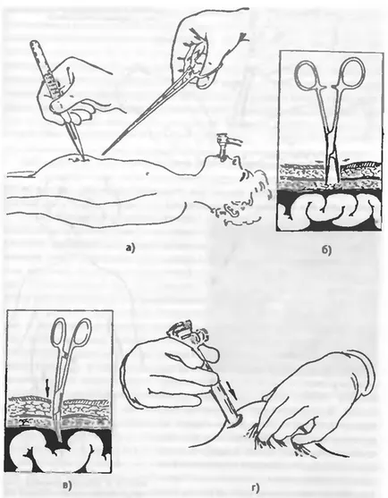 laparoscopie de diagnostic pentru apendicita acuta la copii