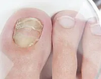 Ефективното лечение на нокти гъбички стартира форма