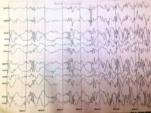 Electroencefalograf (EEG)