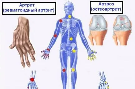 Acest lucru trebuie să știți! Care este diferența dintre artroza, artrita si osteoporoza, mereu în formă!