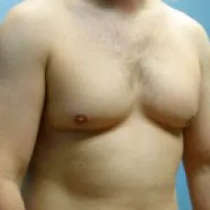 Férfiakban gynecomastia működése és kezelése férfiakban gynecomastia műtét nélkül