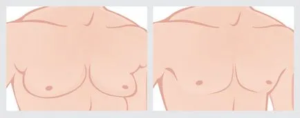 Férfiakban gynecomastia működése és kezelése férfiakban gynecomastia műtét nélkül