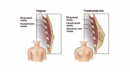 Ginecomastia în funcțiune bărbați și tratamentul ginecomastiei la bărbați, fără o intervenție chirurgicală