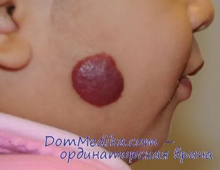 hemangiomas