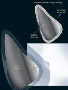 Гръдните импланти Arion (Арион) мнения и разполага моноблок система