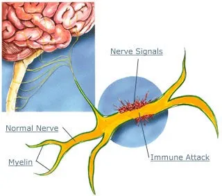 IFN-gamma (de asemenea, cunoscut sub numele de gamma-interferon), stres celular și a sclerozei multiple
