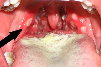 Гъбички в (кандидоза сливиците) на гърлото - faringomikoz