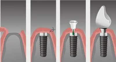 Зъбните импланти в Махачкала, цената на инсталирането на импланти на разположение в съня на клиниката