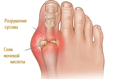 Cât de repede să se retragă cristalele de acid uric din organism, pentru a preveni guta!