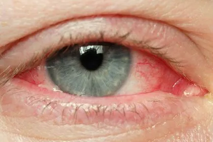 Как да се справим с червени очи намаление