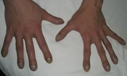 Как да се установи болестта на ноктите
