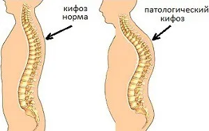 Как да се определи ъгълът на гръдната кифоза