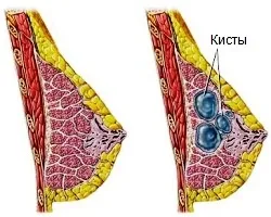 Tratamentul Lactocele medicina intimă din