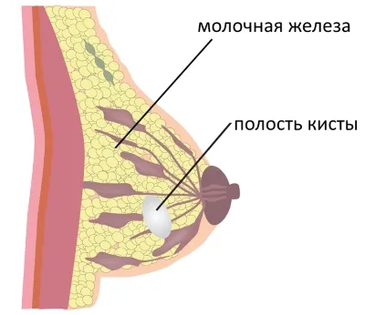 Cauzele Lactocele, simptome și tratament (indepartarea operațională chisturi, droguri), dimensiunea