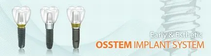 Koreai implantátumok osstem (SCR) termékek, vélemények, árak