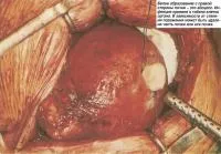 Egy rövid kitérő Urológiában (betegségek - Urology)