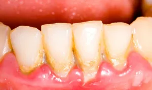 sangerarea gingiilor si respiratia - care fac miroase chiar si dupa periaj