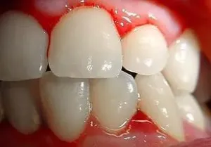 sangerarea gingiilor si respiratia - care fac miroase chiar si dupa periaj