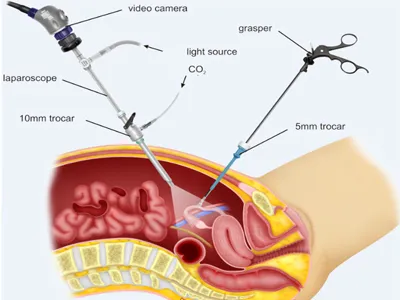 apendicectomie Laparoscopia și caracteristici ale cursul operațiunii