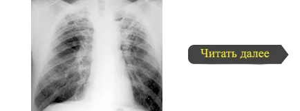 Laboratóriumi diagnózis tuberkulózis