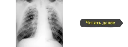 Laboratóriumi diagnózis tuberkulózis