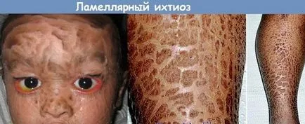 Lemezes (lemezes) ichthyosis kezelése, diagnózisa, fotók a betegek, a BNO-10 kód