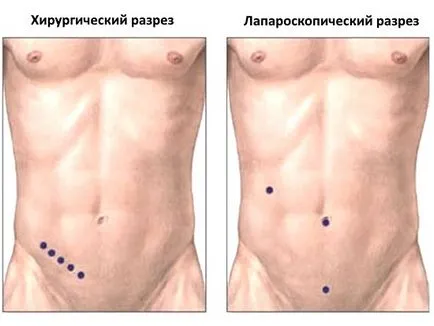 Laparoscopia apendicita operație, de recuperare, dieta