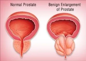 Tratamentul HBP (prostata) în Israel, prețurile, recenziile de cost