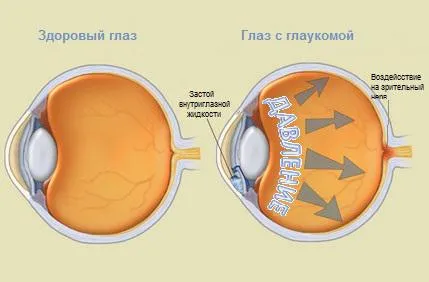 A glaukóma kezelési idős emberek szemében, az elsődleges, betegségek, gyógyszerek otkratougolnaya,