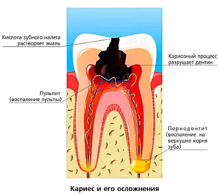 Tratamentul pulpitei și periodontita