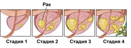 Лечение на рак на простатата в чужбина съвременни методи