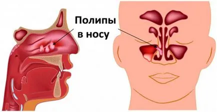 Лечение на полипи в носа причинява на полипоза, симптоми, описание и препоръки