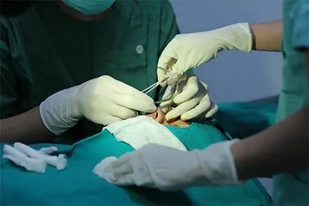 A kezelés a polipok az orrban - az ár a orrpolipok kezelésére műtét nélkül Moszkvában