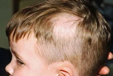 alopecia kezelésére gyermekeknél - csak egy orvos