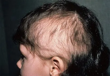 alopecia kezelésére gyermekeknél - csak egy orvos