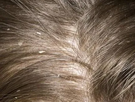 alopecia kezelésére gyermekeknél - csak egy orvos